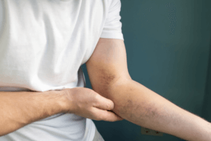 bruising on the arm